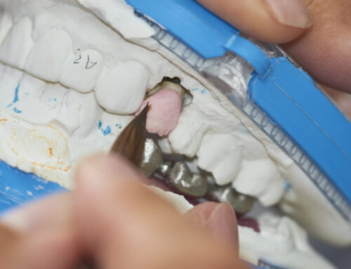 Implantes Dentales: Restaura tu Sonrisa con Confianza y Funcionalidad